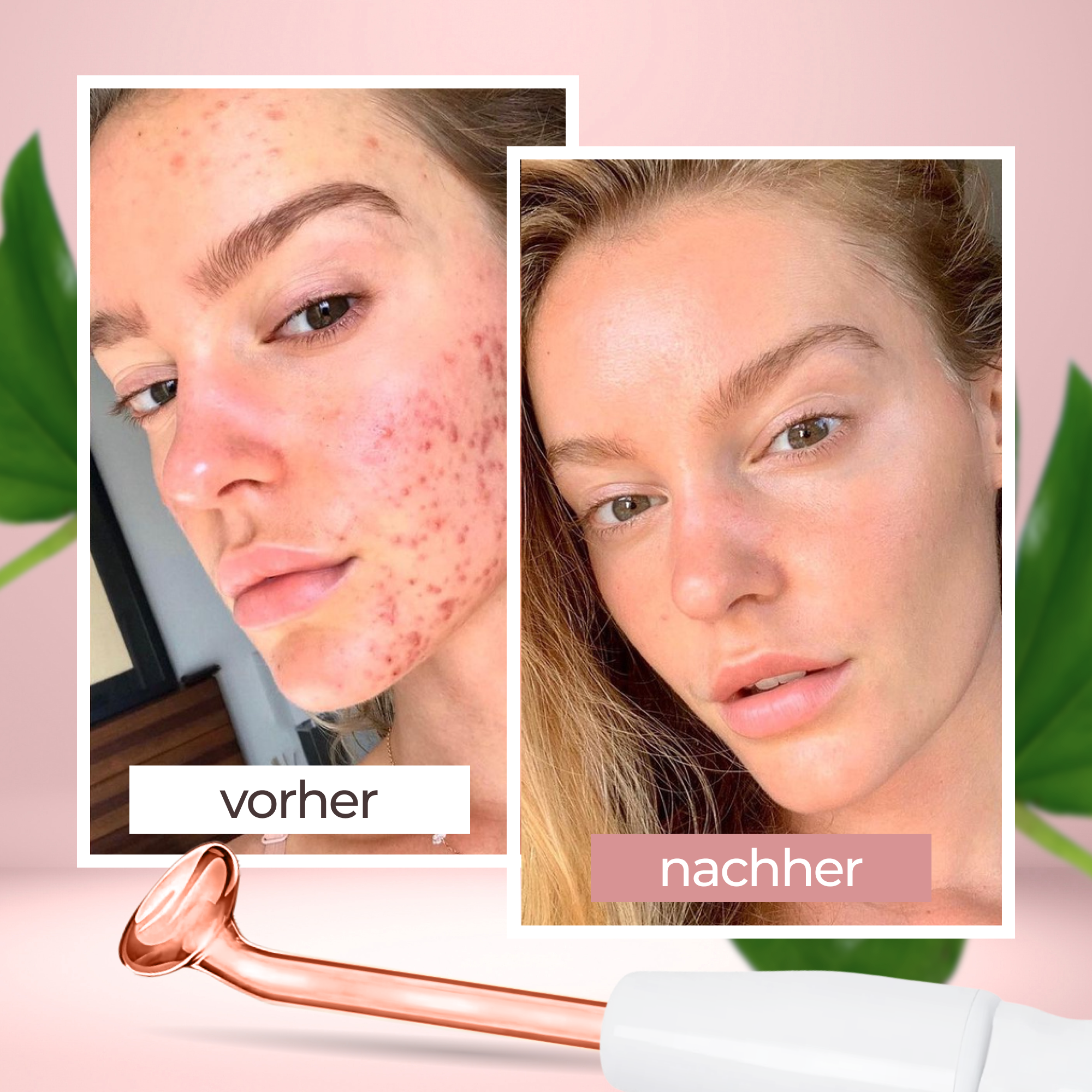 LazuraBeauty™Hochfrequenzstab